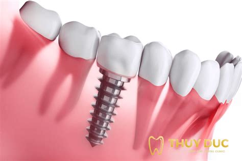 Quy trình trồng răng Implant chuẩn Y khoa