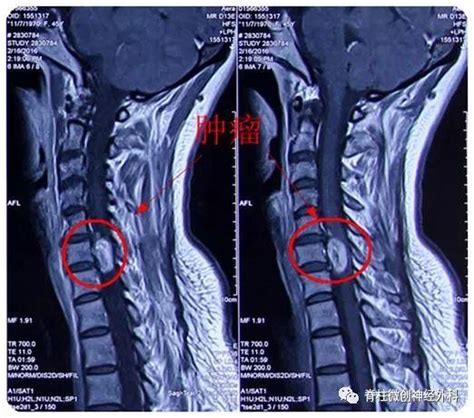 病例：頸椎管內腫瘤被當作頸椎病治療十年 每日頭條