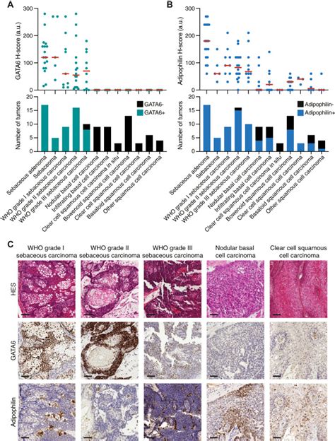 Diagnostic Accuracy Of Gata Immunostaining In Sebaceous Tumors Of The