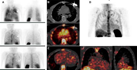 Radiolabeled Leukocyte Scintigraphy 99mTc HMPAO WBC In A Patient With