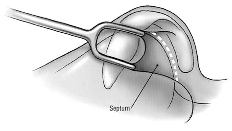 The Tongue In Groove Technique In Septorhinoplasty Jama Facial