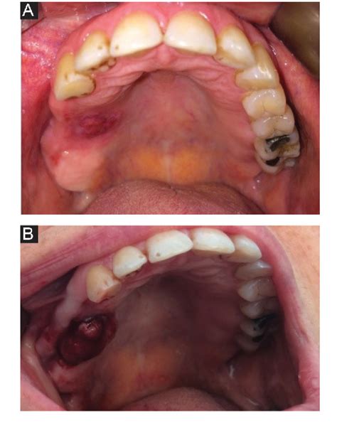 Figure 5 From Management Of A Recurrent Pyogenic Granuloma Of The Hard