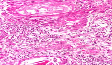 Differential Squamous Cell Carcinoma Of The Endometrium Note The