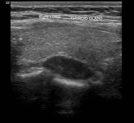 Parathyroid Tumor Ultrasound