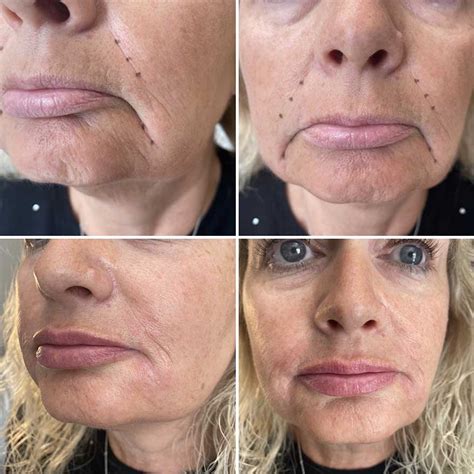 Dermal Fillers Rejuvenate