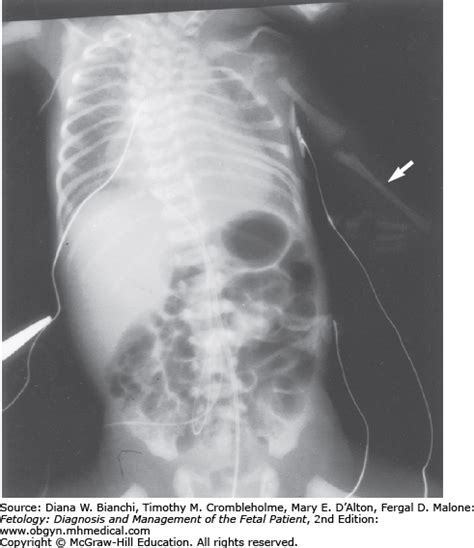 Pyloric Atresia and Stenosis | Obgyn Key