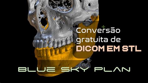 Convers O R Pida E Gratuita De Dicom Em Stl Pelo Blue Sky Plan Youtube