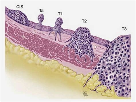 Brady Urology at Johns Hopkins Hospital: Carcinoma In Situ of the ...