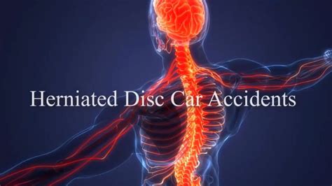 Herniated Disc Car Accidents Spinal Injuries And Highway Accident Attorney In Southern