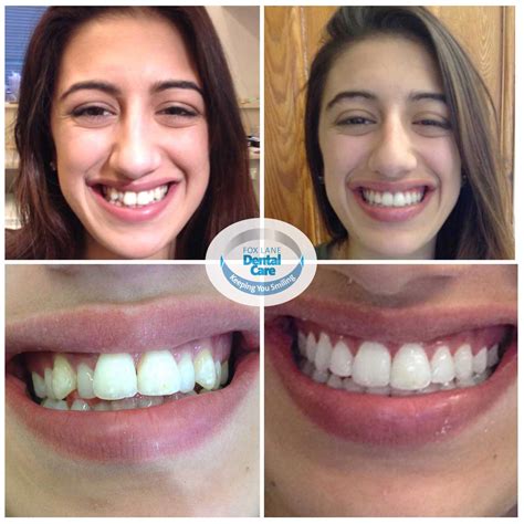 Before And After Of Orthodontic Treatment And Smile Makeovers By Fox