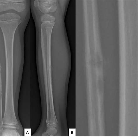 Anteroposterior A And Lateral B Radiographs Of Right Fibula Showing