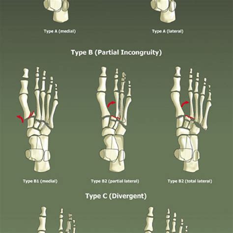 The Myersons Classification Of Lisfranc Injuries 48 From Stavlas Et