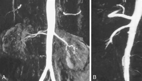 Magnetic Resonance Angiographic Diagnosis Of Renovascular Disease Thoracic Key