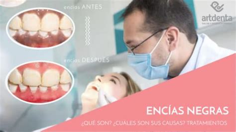 Enc As Negras Qu Son Causas Tratamientos Cl Nica Dental En