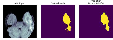 Github Blackbird71srbrain Segmentation And Tumor Detection Modified Vgg16 And Unetcnn Based