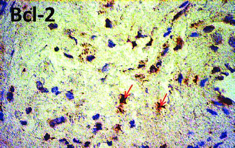 Immunostaining For Bcl 2 In The Nasal Mucosa Of A Control Individual