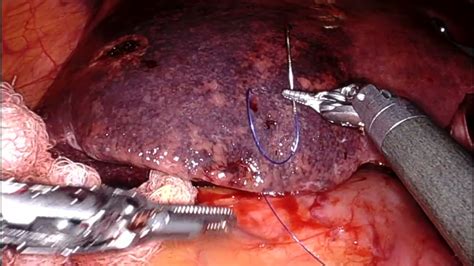 Robotic Right Hepatectomy Youtube