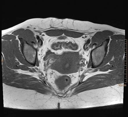 Cesarian scar endometriosis | Radiology Case | Radiopaedia.org