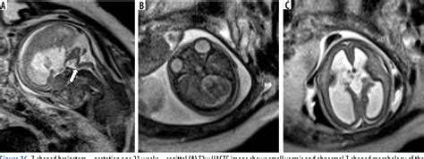 Figure 16 From Imaging Spectrum Of Posterior Fossa Anomalies On Foetal