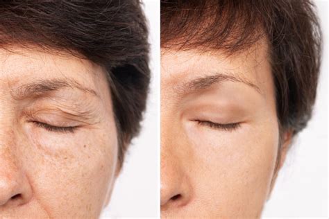 Maximizing Scar Healing After Eyelid Surgery