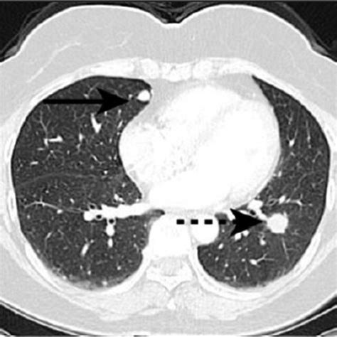 Chest Ct Lung Window Images An 18 Mm Spiculated Nodule With Surface Download Scientific