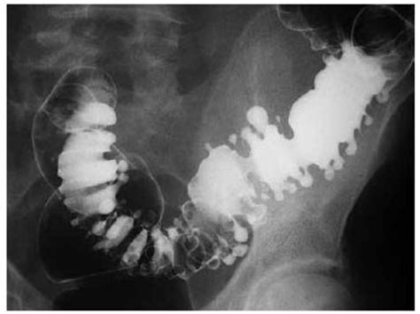 Diverticulite Exames De Imagem