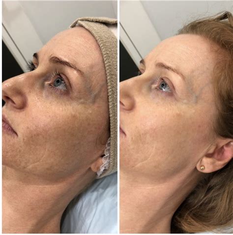 Micro Needling Facial Rejuvenation The Salon