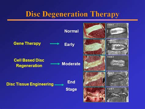 Disc Degeneration Therapy Joshua Li Md Phd