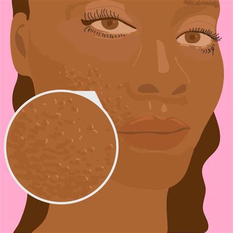 Rosacea In Black And Darker Skin Best Treatments