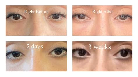 Prf Under Eye Injections R 30PlusSkinCare