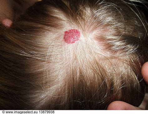 Hemangioma On Scalp Hemangioma On Scalpbenignchildhemangiomanodule