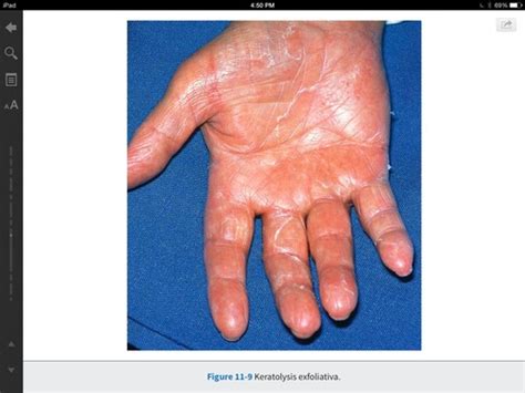 Keratolysis Exfoliativa