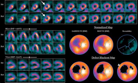 Interpretation Of Spectct Myocardial Perfusion Images Common