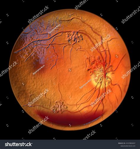 Proliferative Diabetic Retinopathy D Illustration Showing Stock