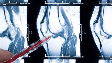 IRM du genou définition comment se passe un examen et y a t il des