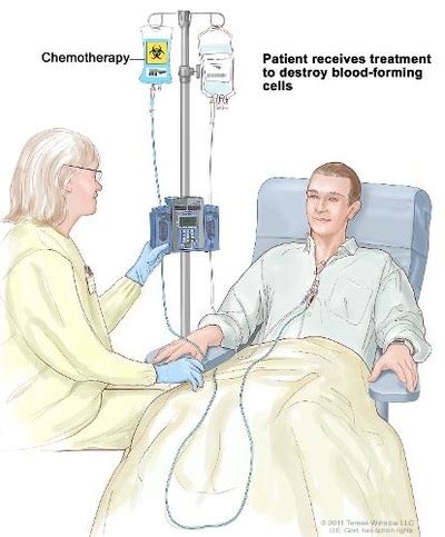 Treatment - Leukemia