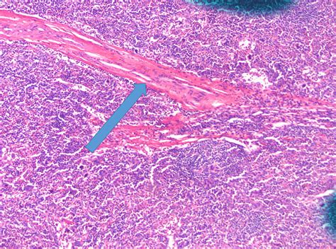 Cervical Lymph Node In 10× With Hyaline Vascular Variant Arrow Download Scientific Diagram