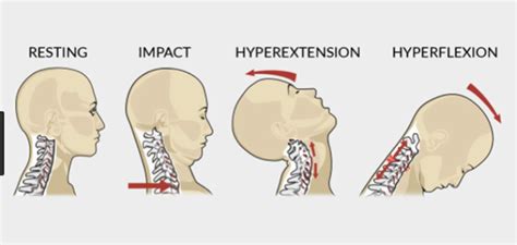 Whiplash Everything You Need To Get Out Of Pain Prehabpro Sports