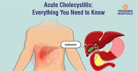 Everything You Need To Know About Acute Cholecystitis