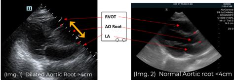 Pocus For Aortic Dissection In The Clinical Presentation Of Ischemic