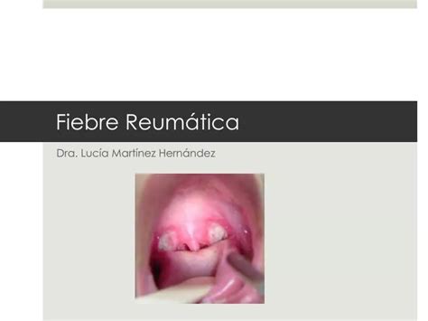 PPT Fiebre Reumática PowerPoint Presentation free download ID 2329170