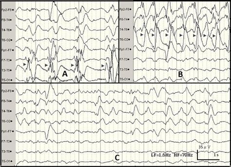 The Patient S Electroencephalography Eeg Showing Bilateral