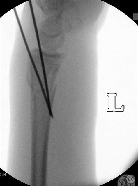 Distal Radius Fracture Kapandji Intrafocal Pinning Technique