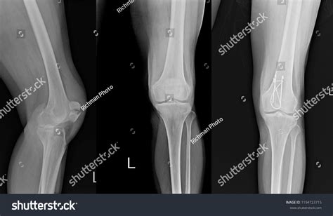 Xray Left Knee Lateral Showing Kneecap Stock Photo Edit Now 1194723715