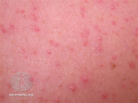 Figure Malassezia Folliculitis Small Erythematous Papules And