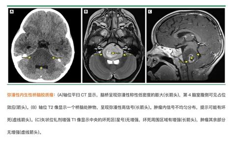 极简医学——弥漫性桥脑胶质瘤 微医（挂号网）