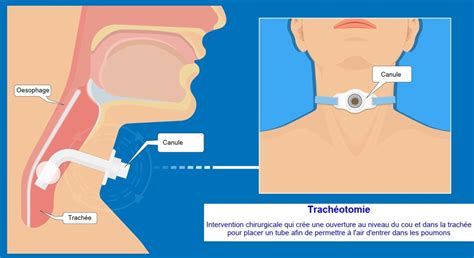 Trach Otomie Corasso