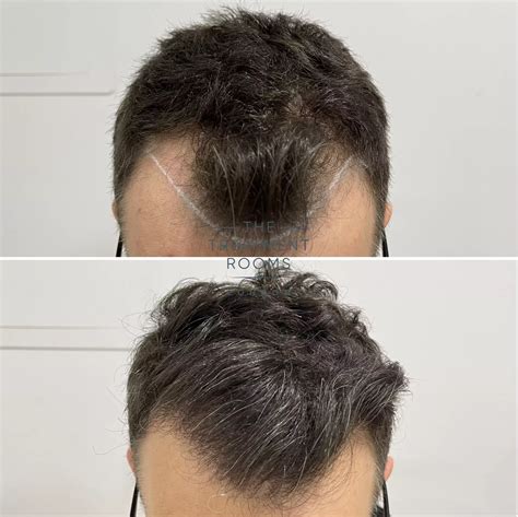 Mature Hairline Vs Receding Hairline, What's The, 46% OFF