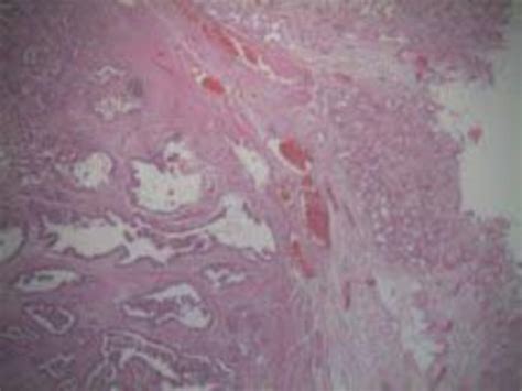 H E Stain Revealing Papillary Adenocarcinoma Infiltrating Throughout