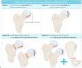 Proximale Femurfrakturen Karteikarten Quizlet